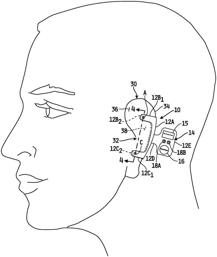 耳廓神经区域刺激设备