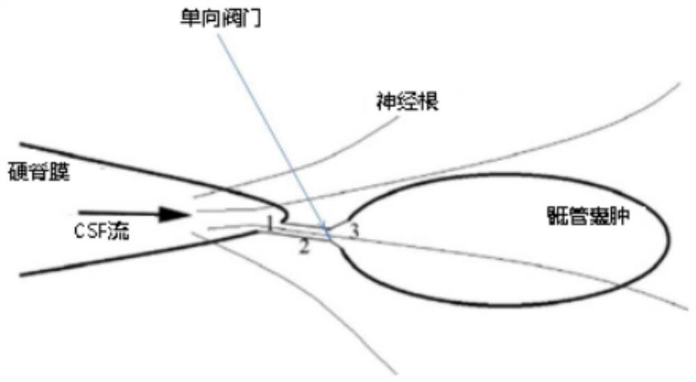 一种建立单向阀门漏口型骶管囊肿大鼠模型的方法