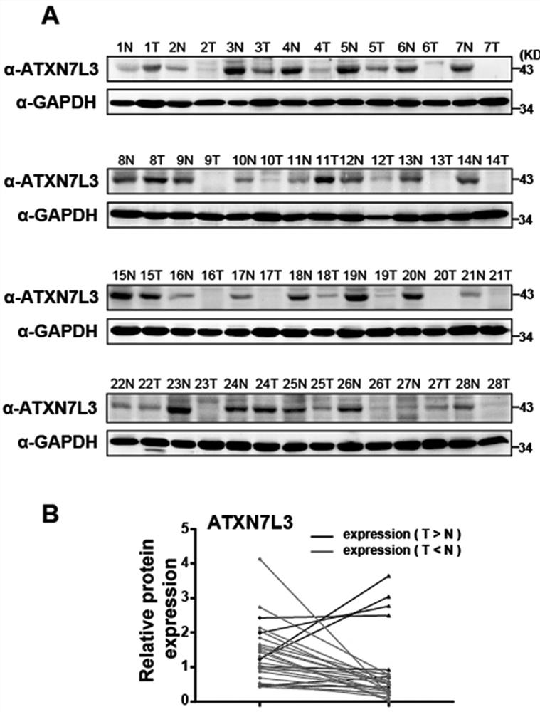ATXN7L3在肝癌诊断、治疗及预后中的应用