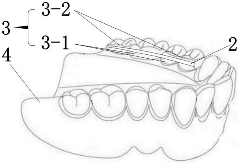 一种义齿修复结构及方法
