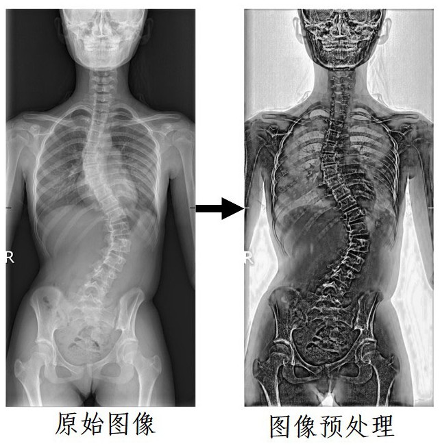 一种基于人工智能-图像识别的脊柱全长X线片测算脊柱侧弯Cobb角的系统及方法