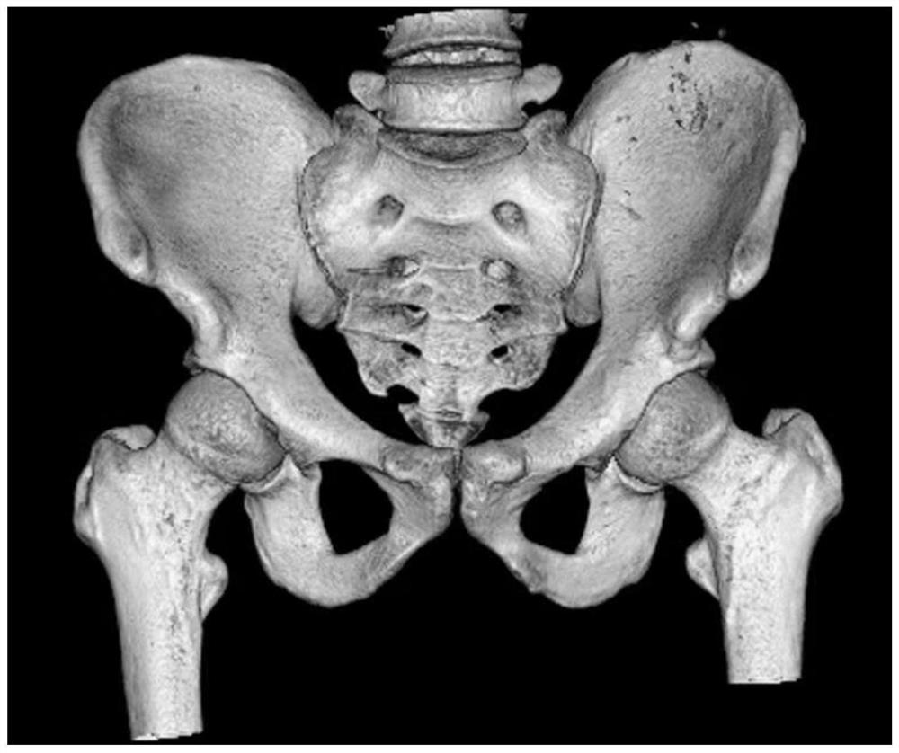 基于骨盆CT图片获得用于快速识别受伤个体的数据的转化方法