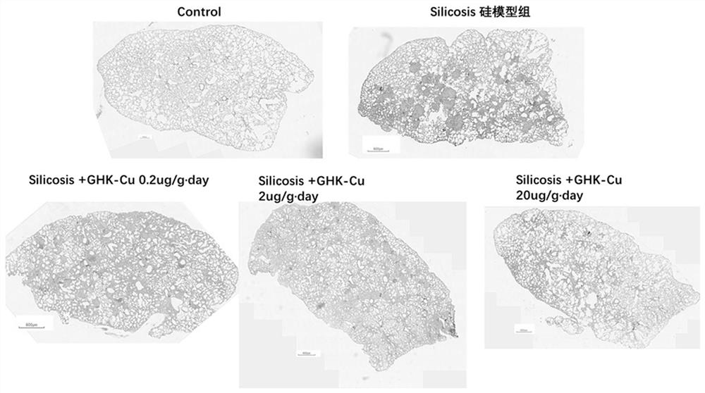 一种三肽化合物及其铜离子螯合物在预防和治疗矽肺中的应用