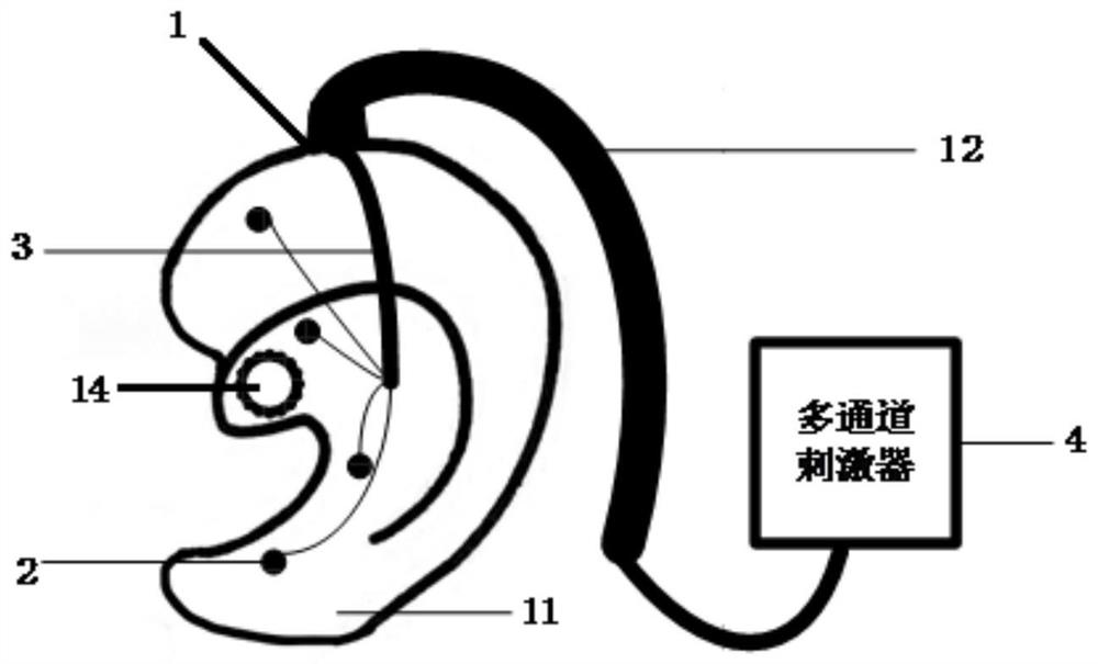 一种耳塞式耳穴电极刺激装置