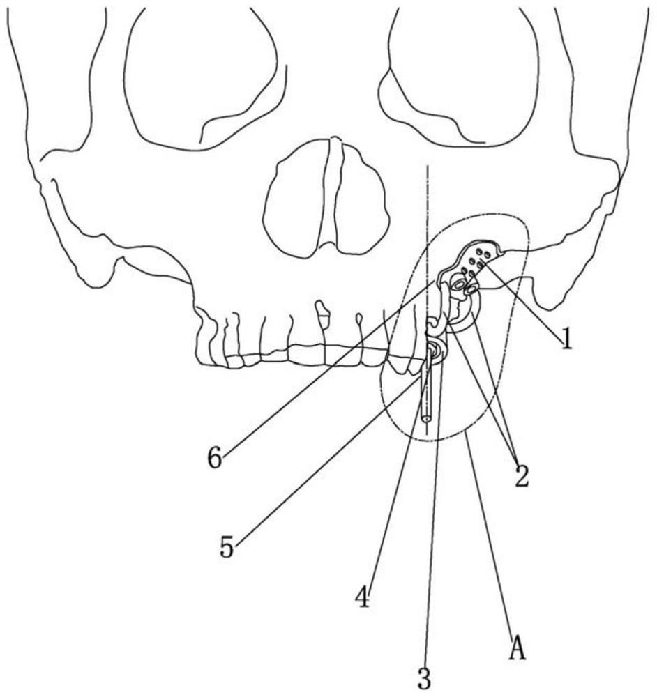 基于三维打印技术的骨支持式上颌后部长植体种植导座
