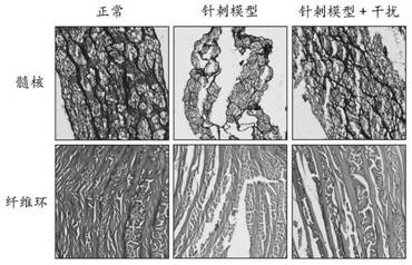 ZIP8作为腰椎间盘退变治疗靶点的应用