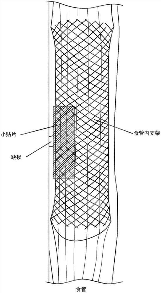 用于中空器官的内表面上的体内组织再生的方法和装置