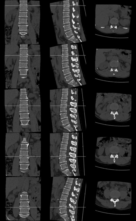 应用于CT影像的腰椎间盘观测面定位方法、装置及应用