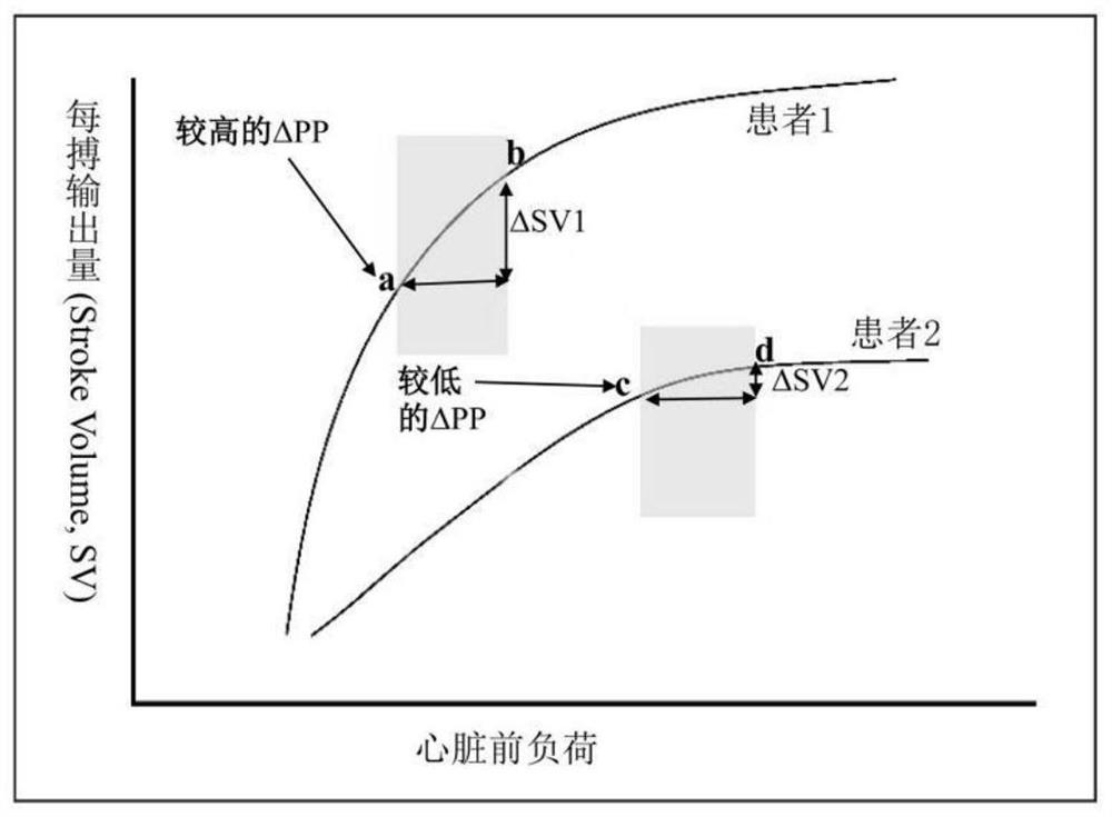 呼吸力学校正的脉搏压力变异度的专项评估方法