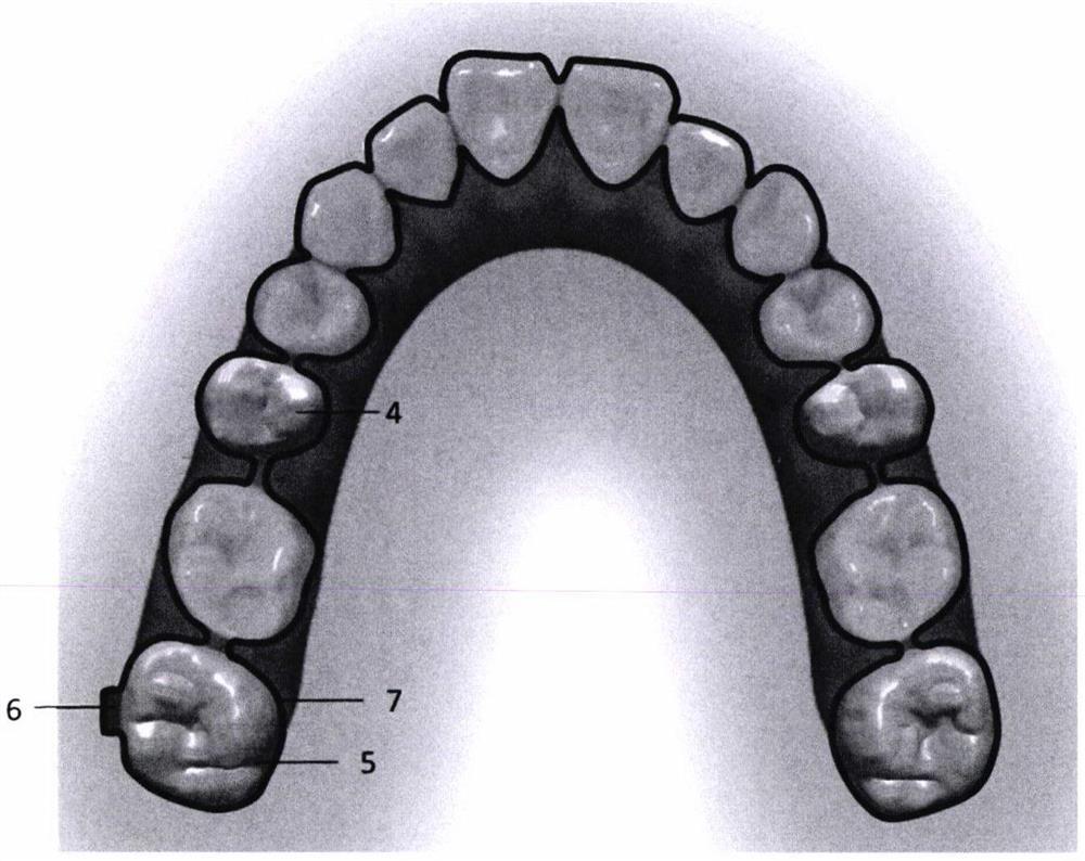基于牙齿多个位置重叠模型生产的无托槽隐形矫治器及其制作方法
