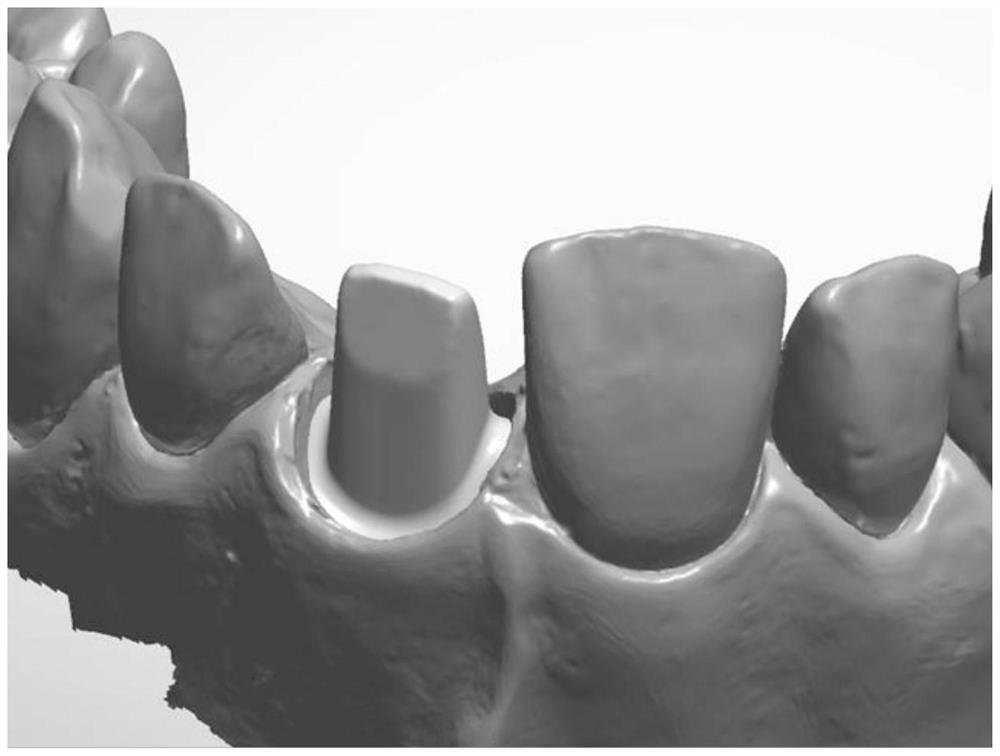 利用生物解剖结构愈合扫描体制作牙冠或基台的方法