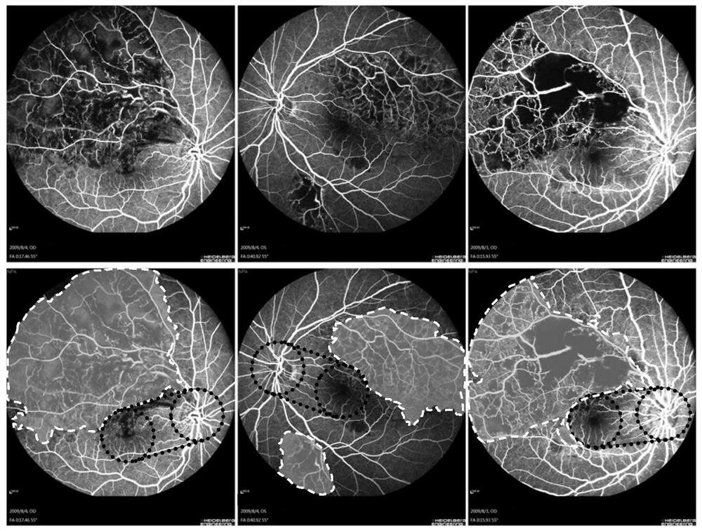 眼底造影图像无灌注区自动识别及激光光凝区域推荐算法
