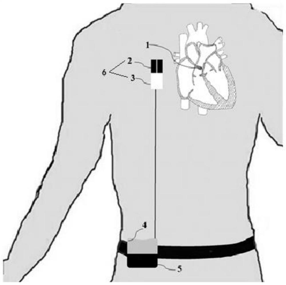 一种植入式右心辅助系统