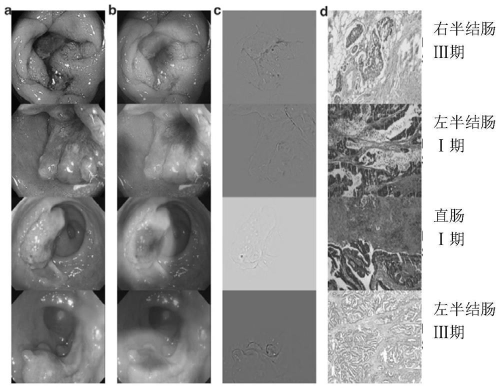 一种肠癌辅助诊断模型构建和辅助诊断方法及系统