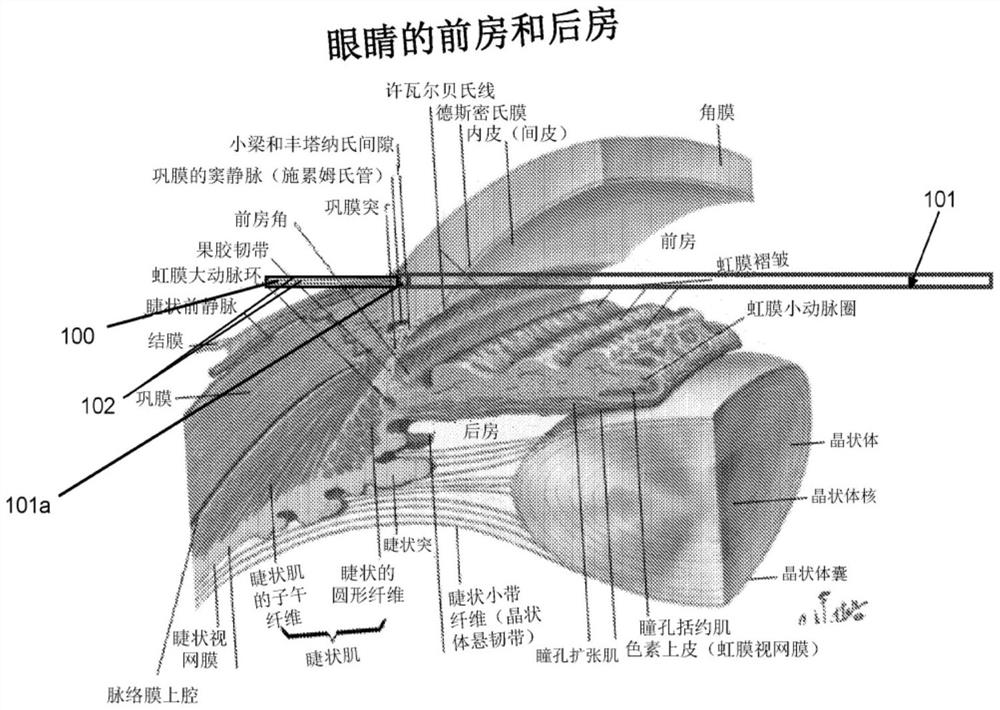 用于微创青光眼手术的激光辅助技术的系统和方法