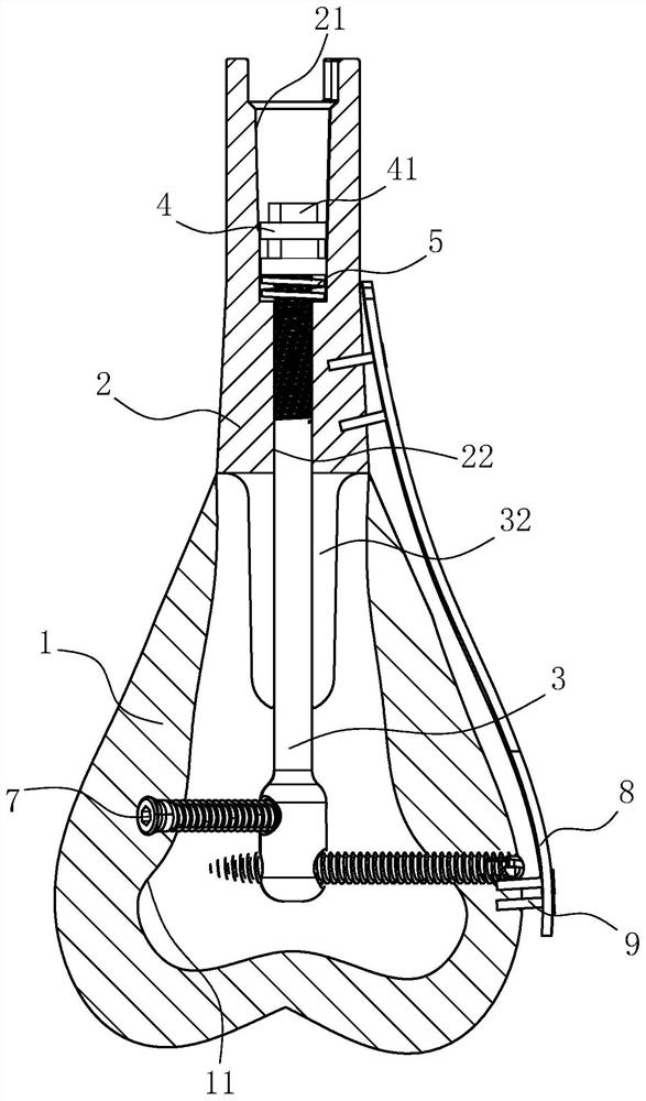 干骺端骨缺损髓内轴向加压固定假体