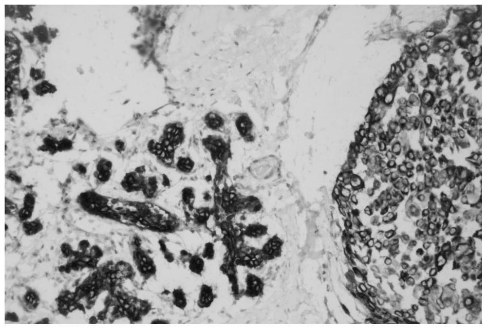 一种用于诊断乳腺癌的鸡尾酒免疫组化试剂盒