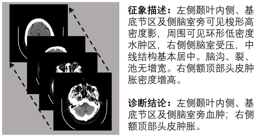 一种于基于弱监督注意力的脑CT医学报告自动生成方法