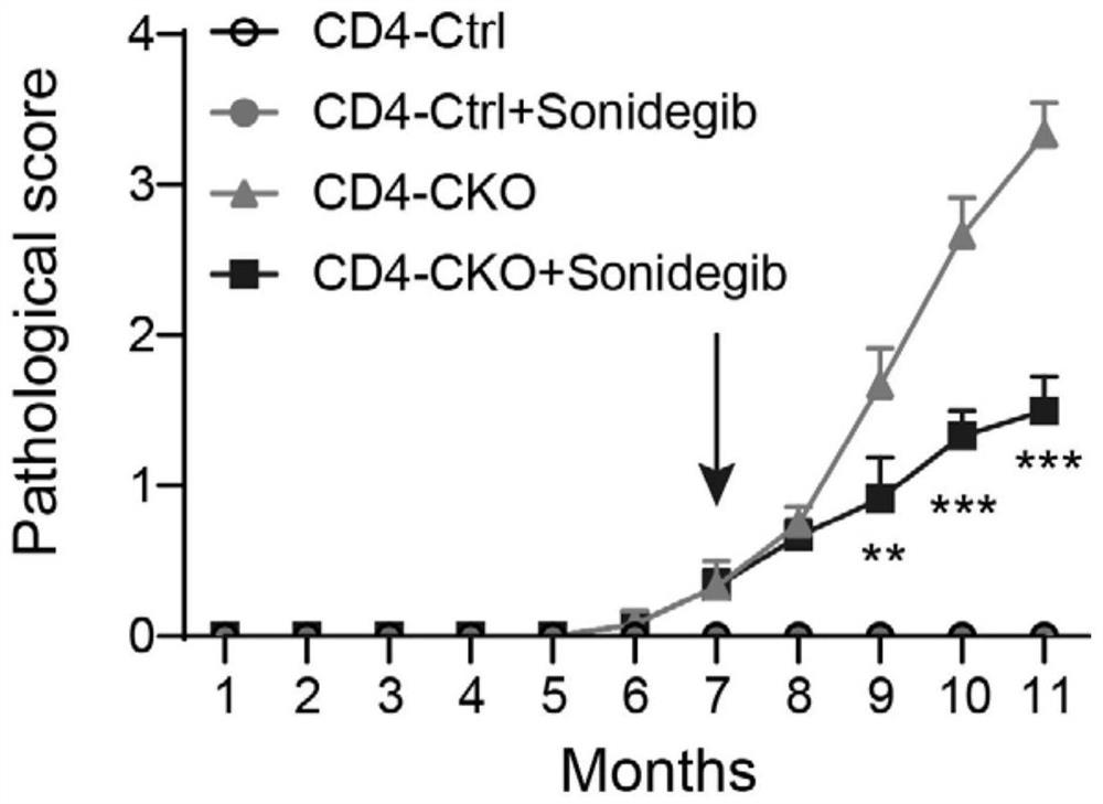 Sonidegib在制备治疗强直性脊柱炎药物中的应用