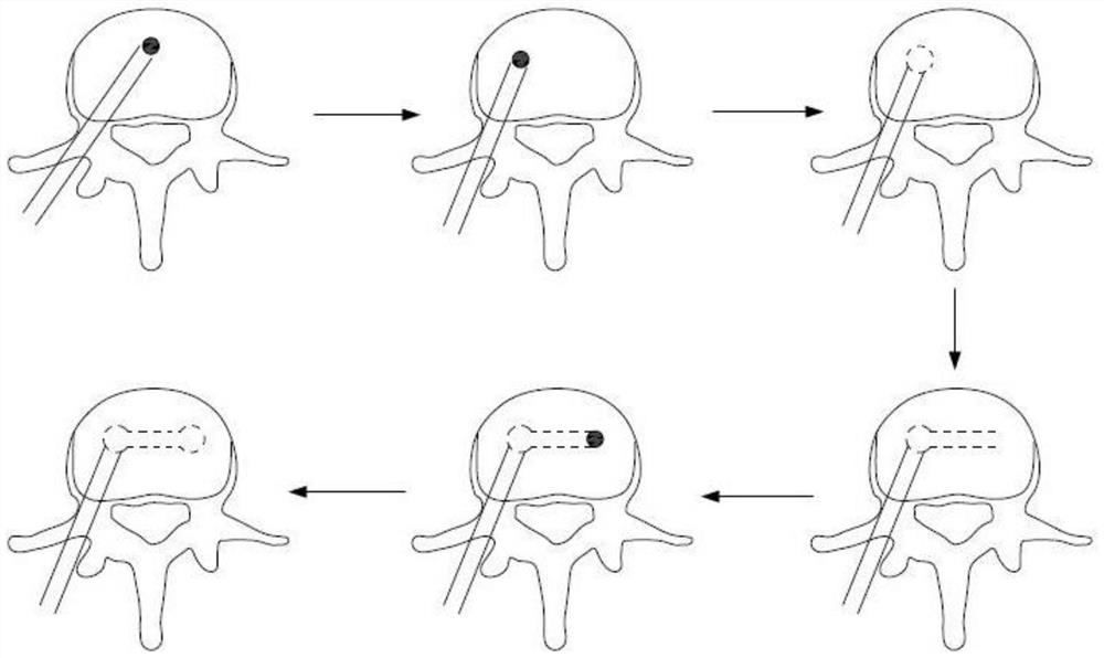 一种单侧多中心椎体成形术