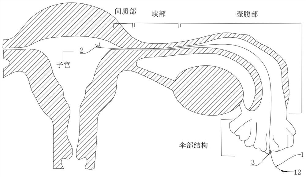 用于PUSH手术的输卵管间质部的定位组件