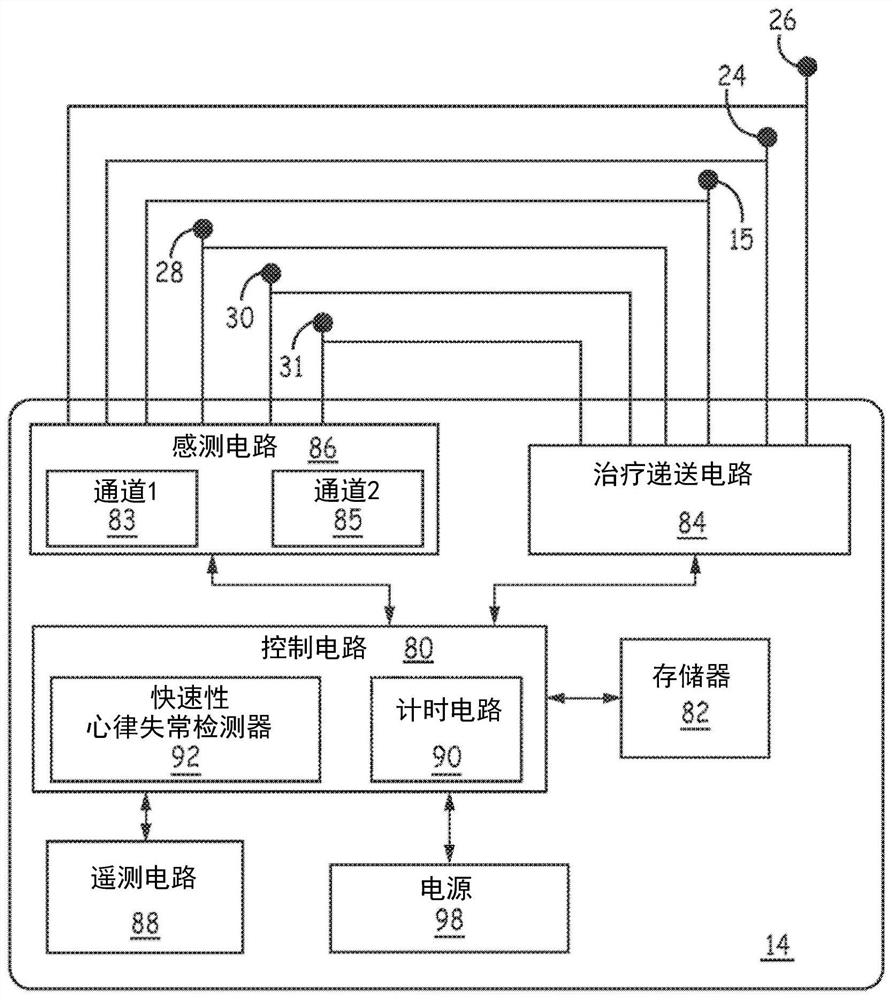 用于在心血管外植入式复律除颤器中进行感测和检测的系统及方法