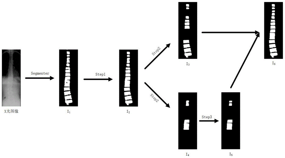 一种脊柱侧弯Lenke分型系统