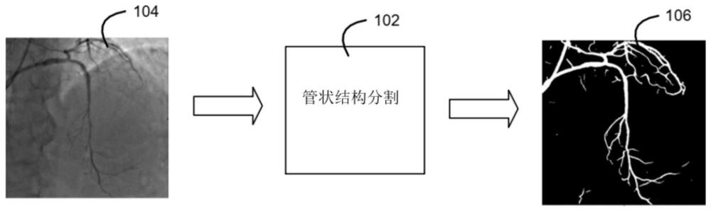 管状结构分割的设备和方法