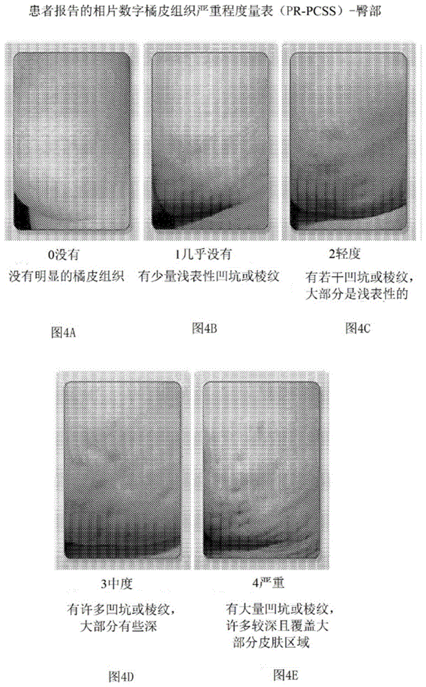 用于评估和治疗橘皮组织的装置和方法