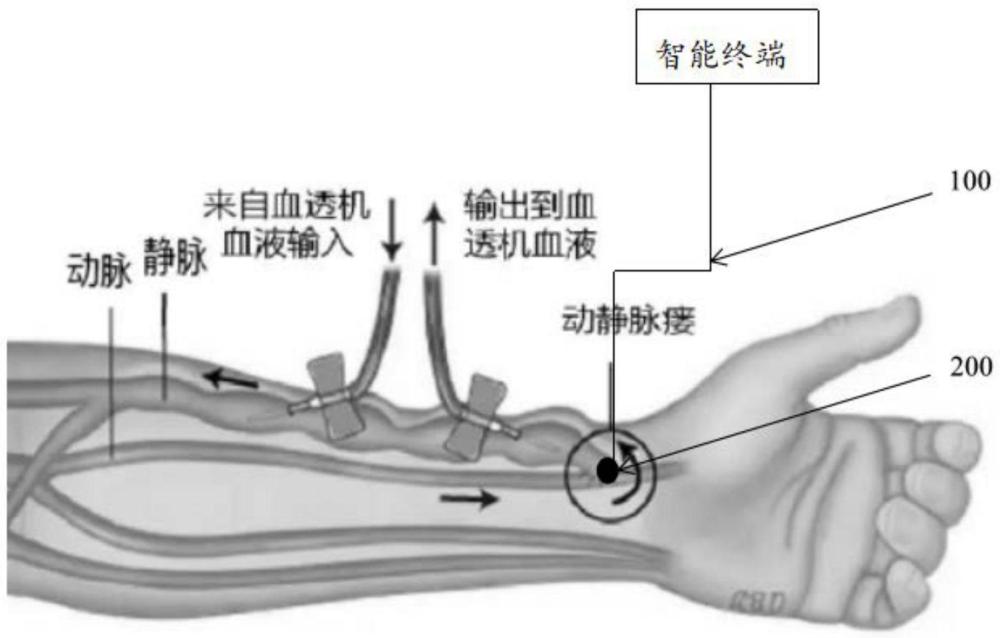 血透患者智能听诊器、系统和应用方法