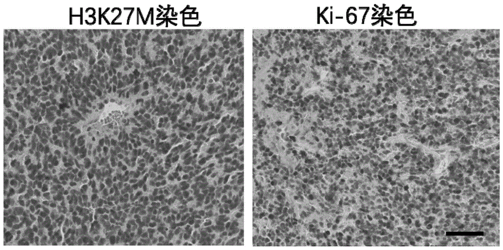 一种H3K27M突变型脊髓胶质瘤细胞及其培养方法